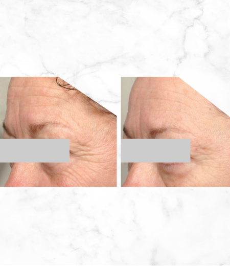 X LIFTING SHOT Peptid-Konzentrat 30 ml